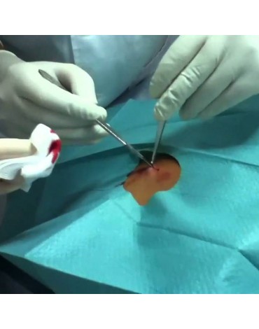 Resection of epididymis cyst