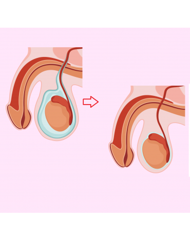 Hydrocelectomy