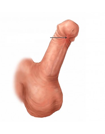 Frenulectomía por frenillo del pene