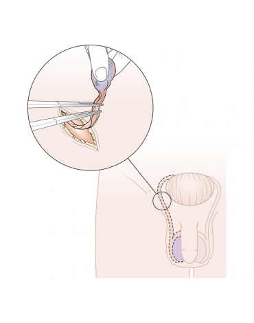 Radical orchiectomy