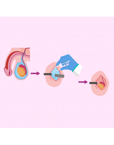 Hydrocelectomy