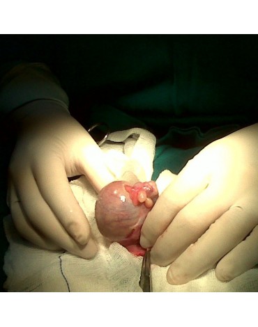 Resection of epididymis cyst