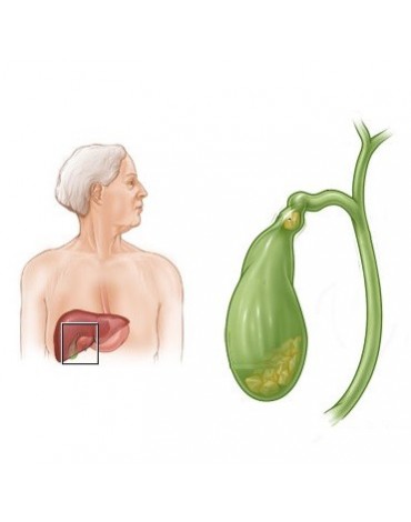 Gallbladder surgery