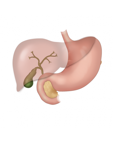 Gallbladder surgery