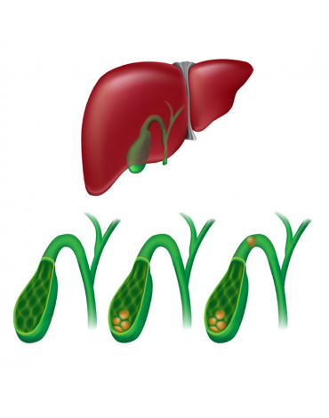 Gallbladder surgery