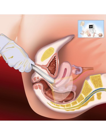 Ultrasonido vaginal obstétrico y ginecológico
