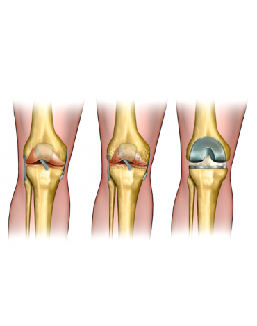 Total knee replacement