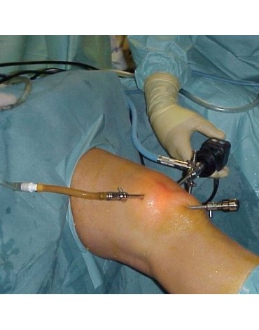 Knee arthroscopy + meniscectomy + ACL reconstruction