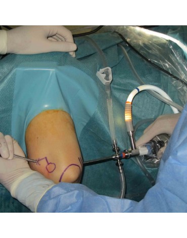 Knee arthroscopy + meniscectomy + ACL reconstruction