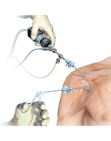 Shoulder arthroscopy + rotator cuff repair