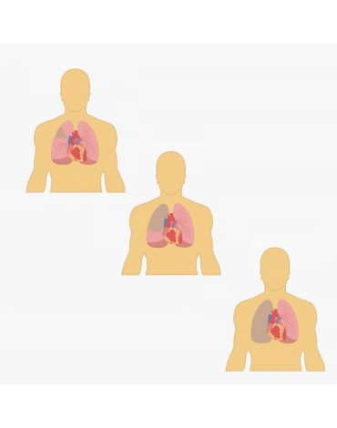 Cirugía de cáncer pulmonar (resección pulmonar)