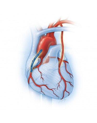 Cirugía bypass coronario