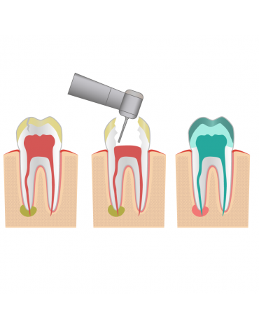 Anterior endodontics (unirradicular)