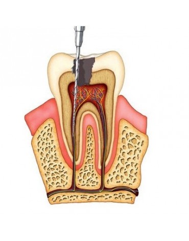 Premolars endodontics (birradiculares)