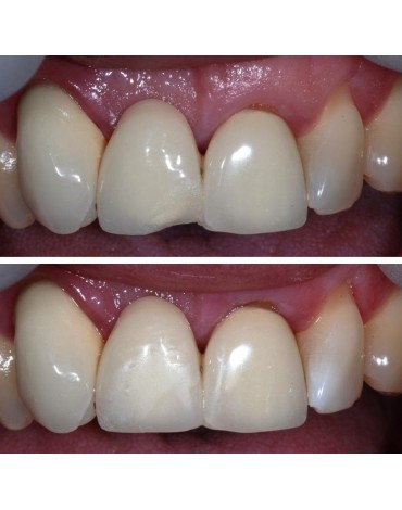 Resin restorations (resin filling)