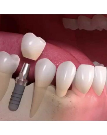 Crown On Implant anterior sector (cover on implant)