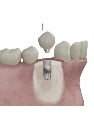 Crowns On Implants (sheath on implant)