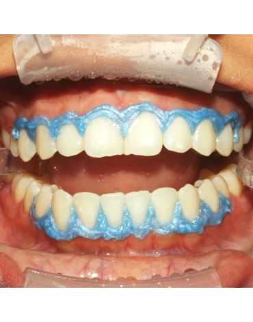 Intracoronal whitening by appointment