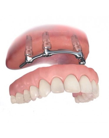 Upper and lower overdenture
