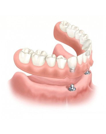 Upper and lower overdenture
