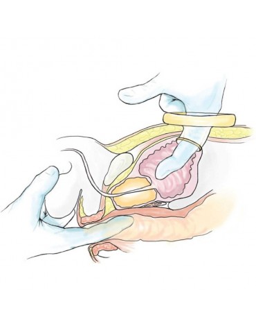 Prostatectomia transvesical