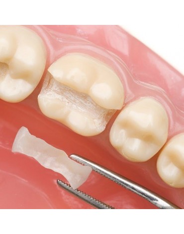 Zirconium and / or porcelain inlays (zirconium and / or porcelain graft)