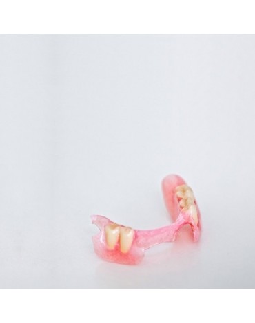Acrylic removable partial denture (acrylic removable partial denture)