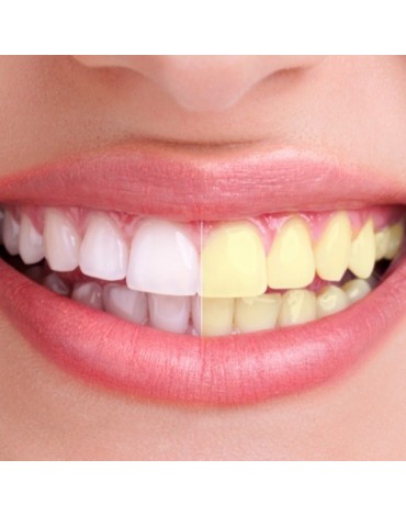 Teeth whitening