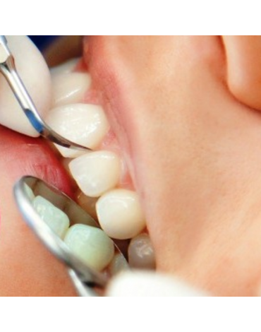 Limpieza dental (profiláctica dental)