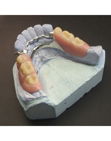 Prótesis sobre ataches dentales