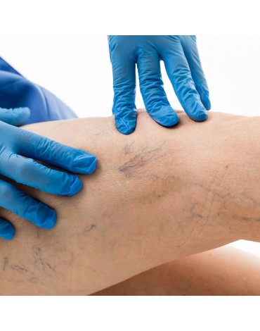 Treatment of leg veins (each session)