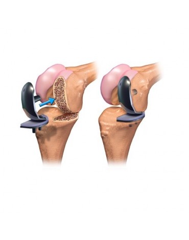 Knee replacement