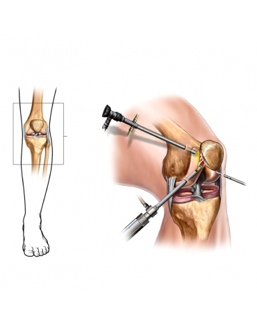 Knee arthroscopy