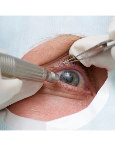 Cataract surgery with trifocal lens (one eye)