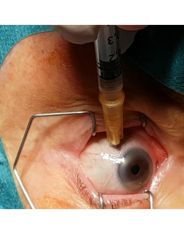 Intravitreal injection for macular degeneration with Eylea medication