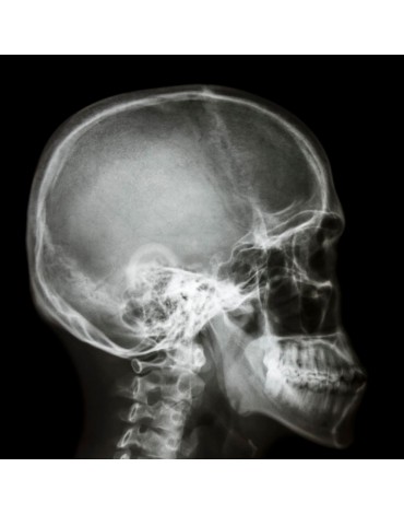 X-ray of skull ap and lat