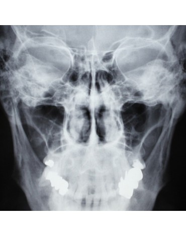 X-ray of paranasal sinuses