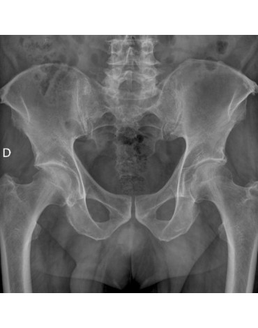 Radiografía de cadera ap y oblicua