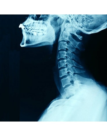 Radiografía de columna cervical ap y lateral