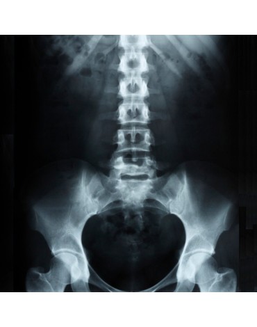 X-ray of  lumbosacral column - coxis