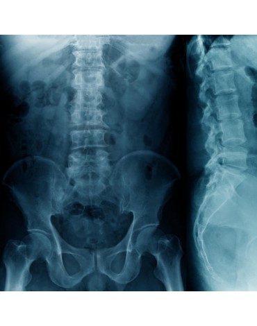 Radiografía de columna dorsolumbar (Ap y Lat)