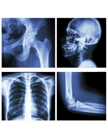 X-ray of the metastatic osseous series