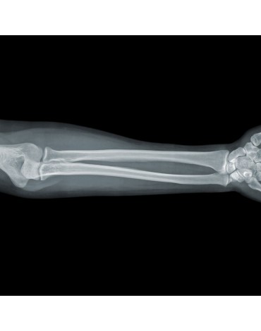 X-ray of forearm (radio - ulna)