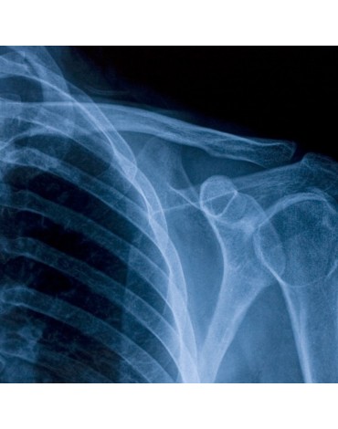 X-ray of clavicle ap