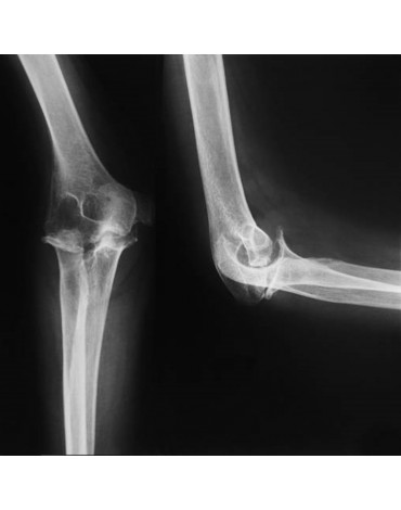 X-ray of elbow (ap and lat)