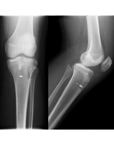 X-ray of elbows (both)