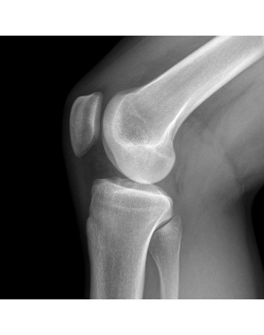 X-ray of tangential knee ap / lat and axial