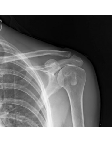 X-ray of shoulder ap