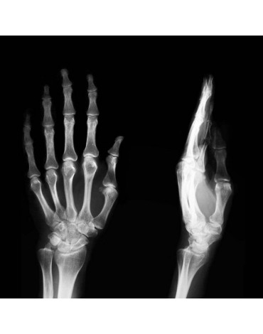 Scaphoid series radiography