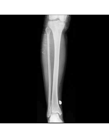 X-ray of the leg